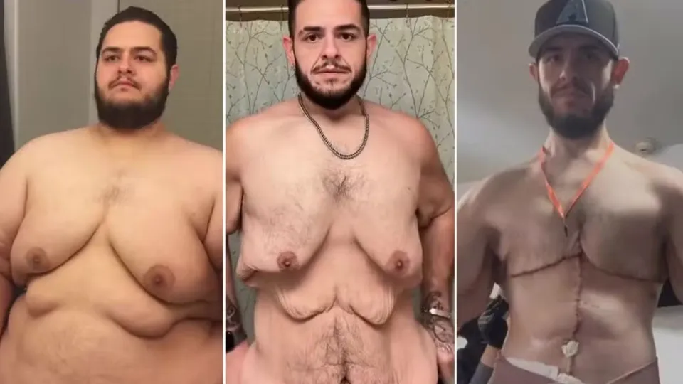 Antes e Depois: Influencer perde 150 kg e retira 7 kg de excesso de pele